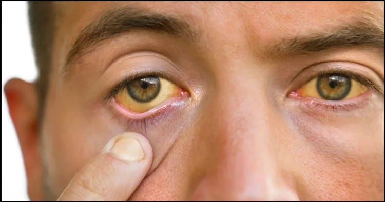 India becomes trachoma free country