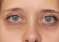 How To Remove Dark Circles