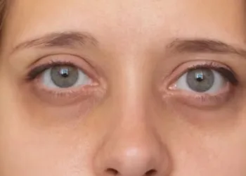 How To Remove Dark Circles
