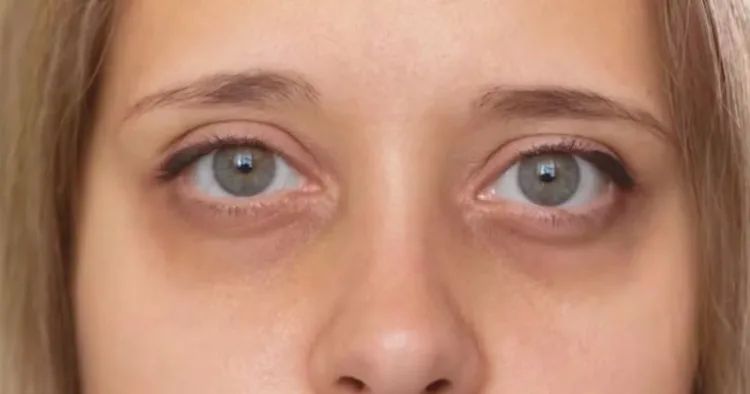 How To Remove Dark Circles