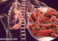 Punjab Haryana TB Cases Increasing Report